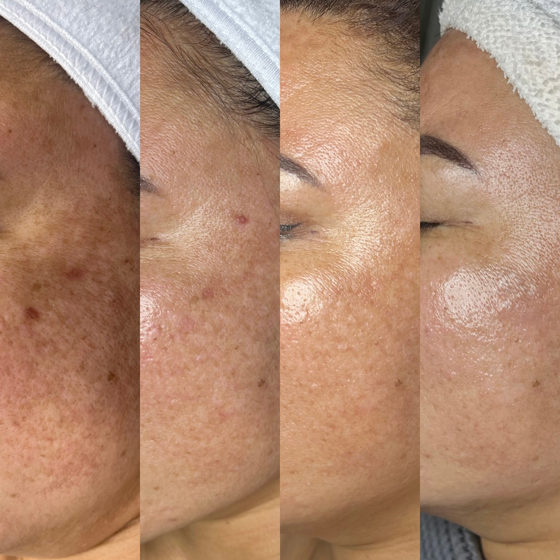 Before and after — Collagen Renewal series and lunar peels